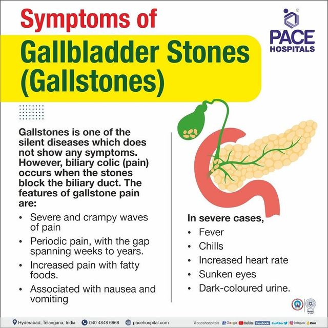 Gallstones causes deals